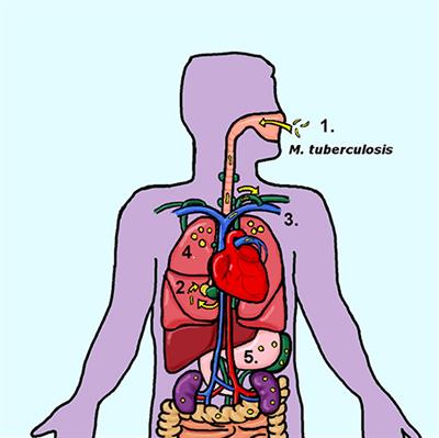 Mycobacterium tuberculosis Dissemination Plays a Critical Role in Pathogenesis